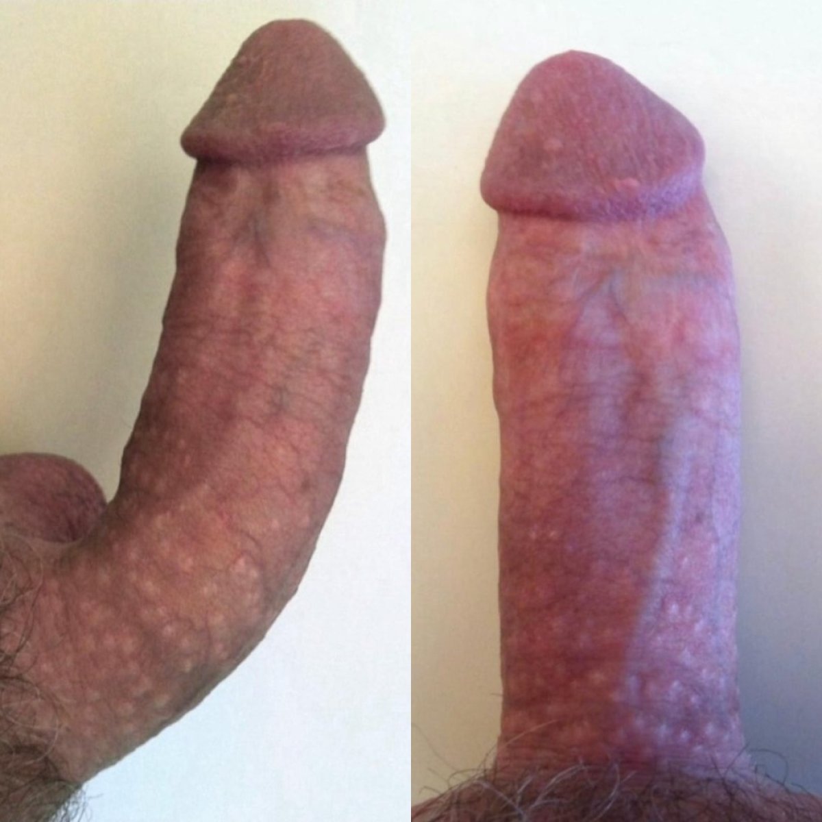 Antes y después de corrección de curvatura peneana en Safe Urology Clinic, resultado de Peyronie
