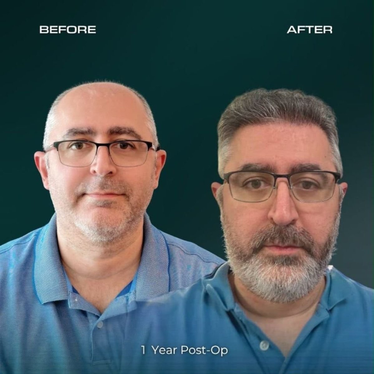 Before and after Sapphire FUE hair transplant result at NOVİN ARİANA SAĞLIK VE TURİZM LİMİTED ŞİRKETİ