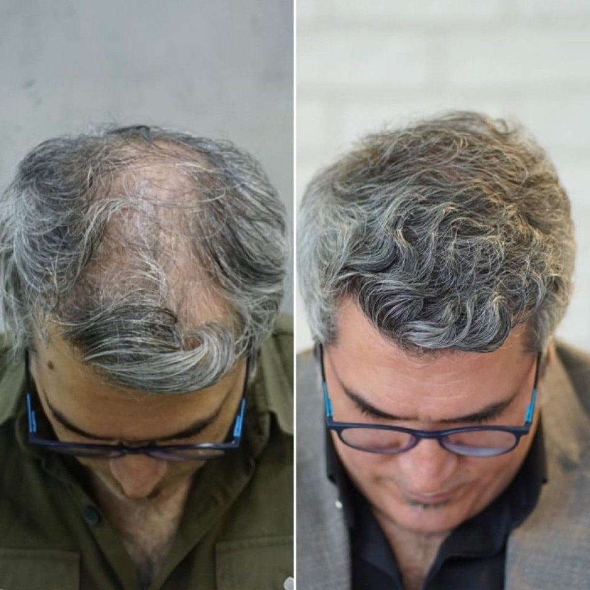 Before and after FUE hair transplant result at NOVİN ARİANA SAĞLIK VE TURİZM LİMİTED ŞİRKETİ