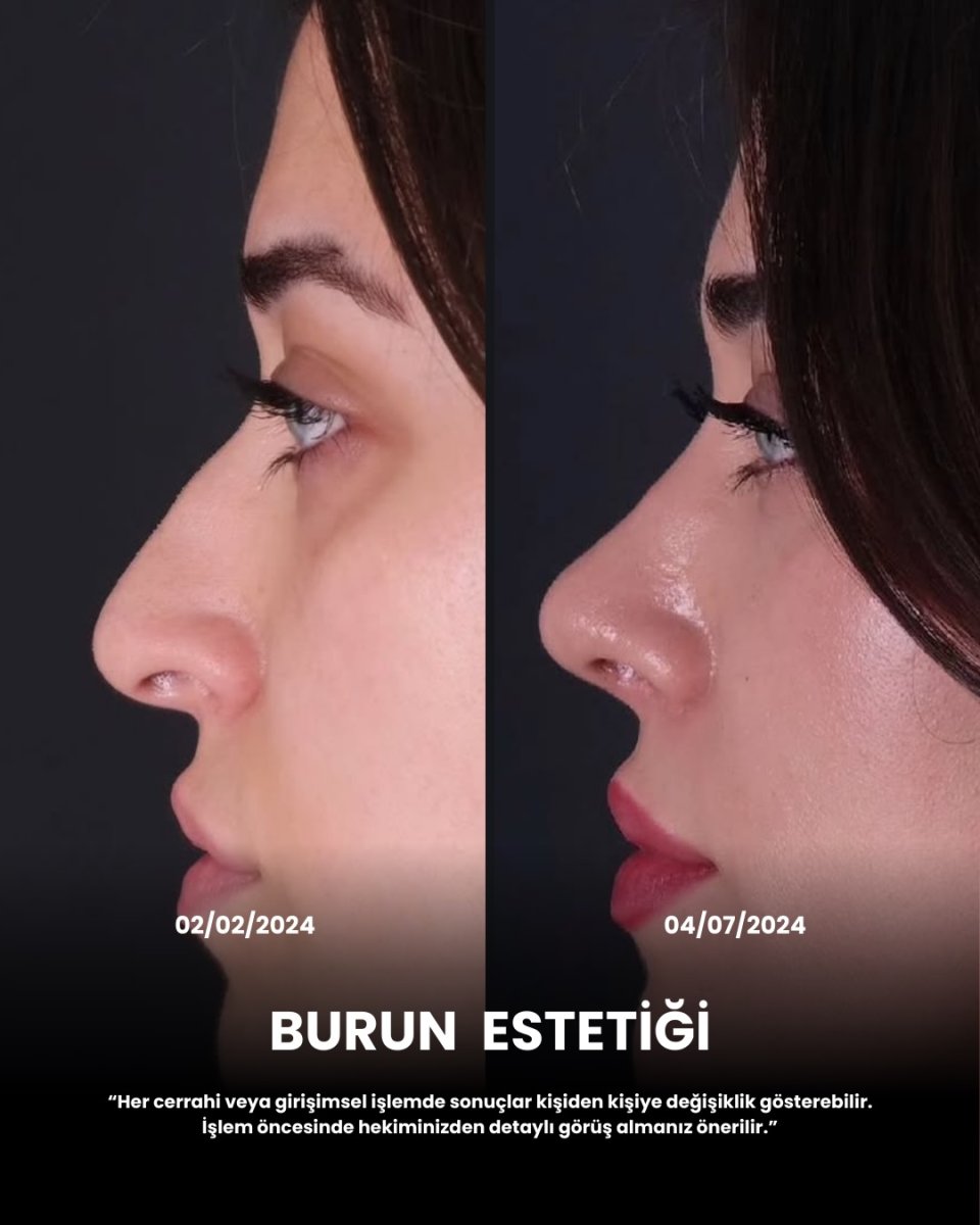 نتائج تجميل الأنف قبل وبعد، تحسين طبيعي لشكل الأنف الجانبي