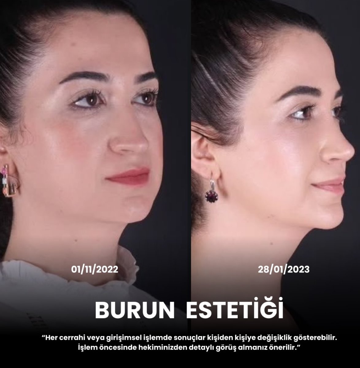 نتائج تجميل الأنف قبل وبعد، إعادة تشكيل واضحة وتحسين مظهر الأنف الجانبي