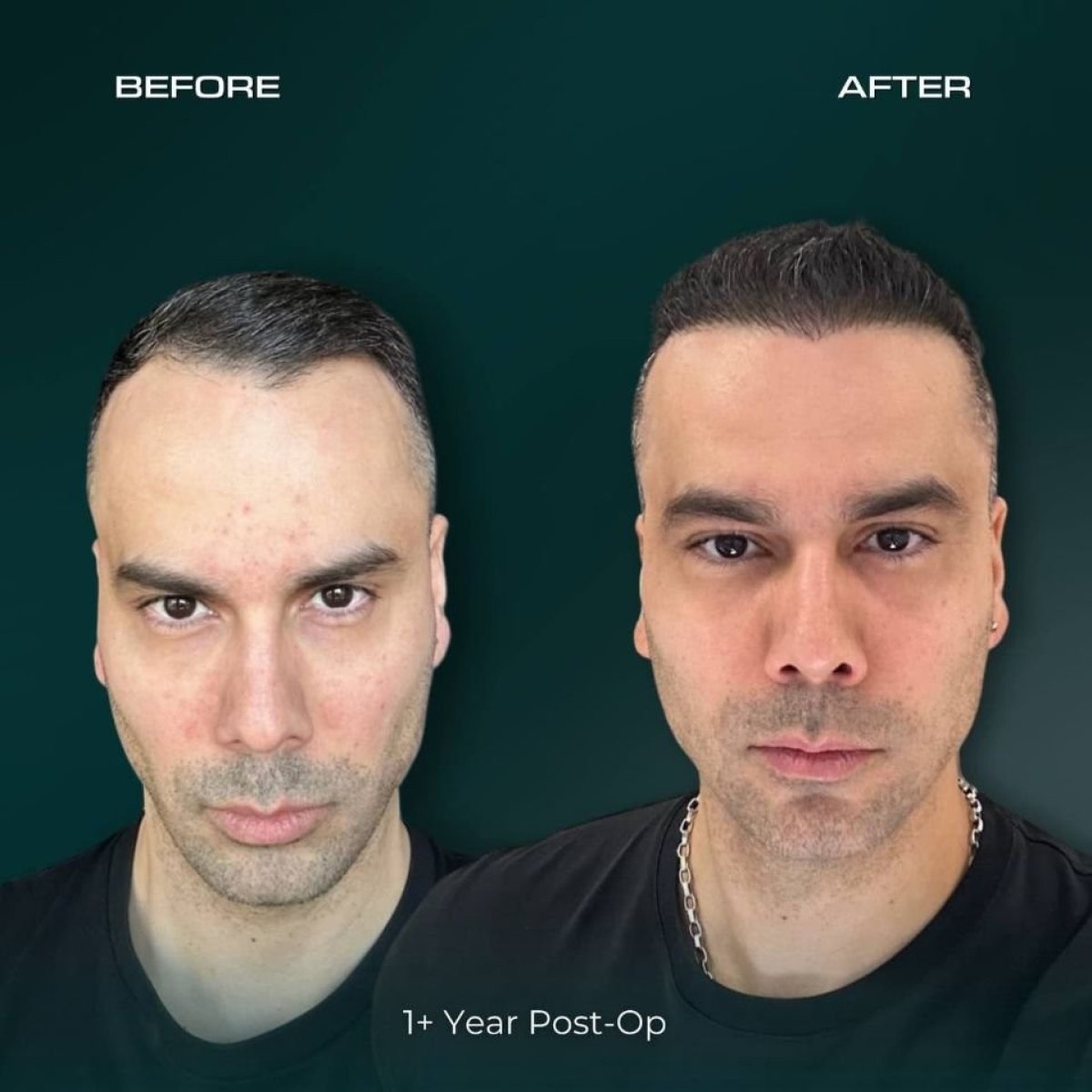 نتيجة زراعة الشعر FUE قبل وبعد في NOVİN ARİANA SAĞLIK VE TURİZM LİMİTED ŞİRKETİ