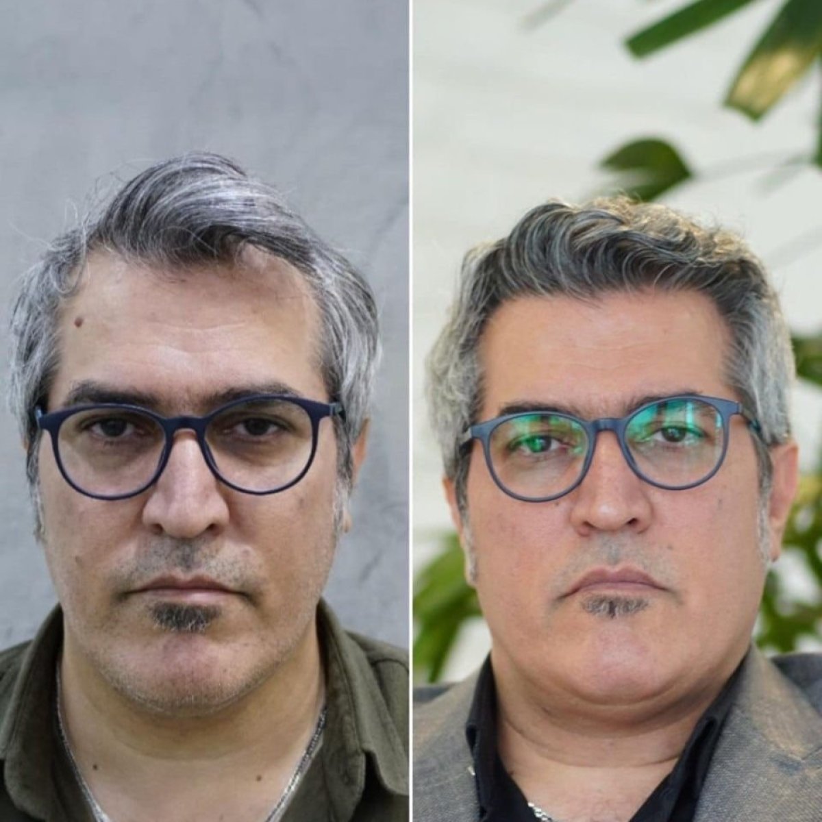 نتائج زراعة الشعر FUE قبل وبعد في NOVİN ARİANA SAĞLIK VE TURİZM LİMİTED ŞİRKETİ