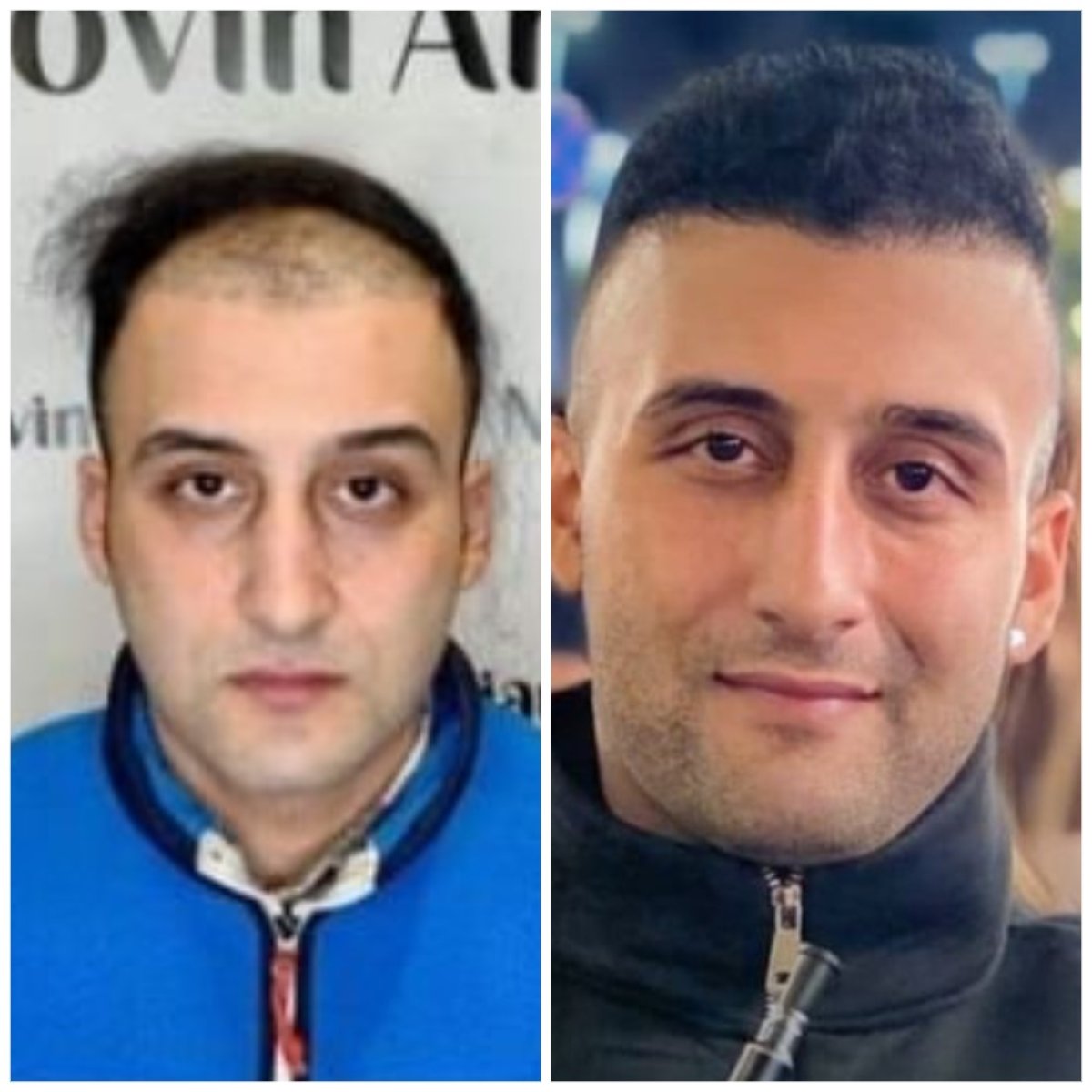 Результаты до и после пересадки волос FUE в NOVİN ARİANA SAĞLIK VE TURİZM LİMİTED ŞİRKETİ