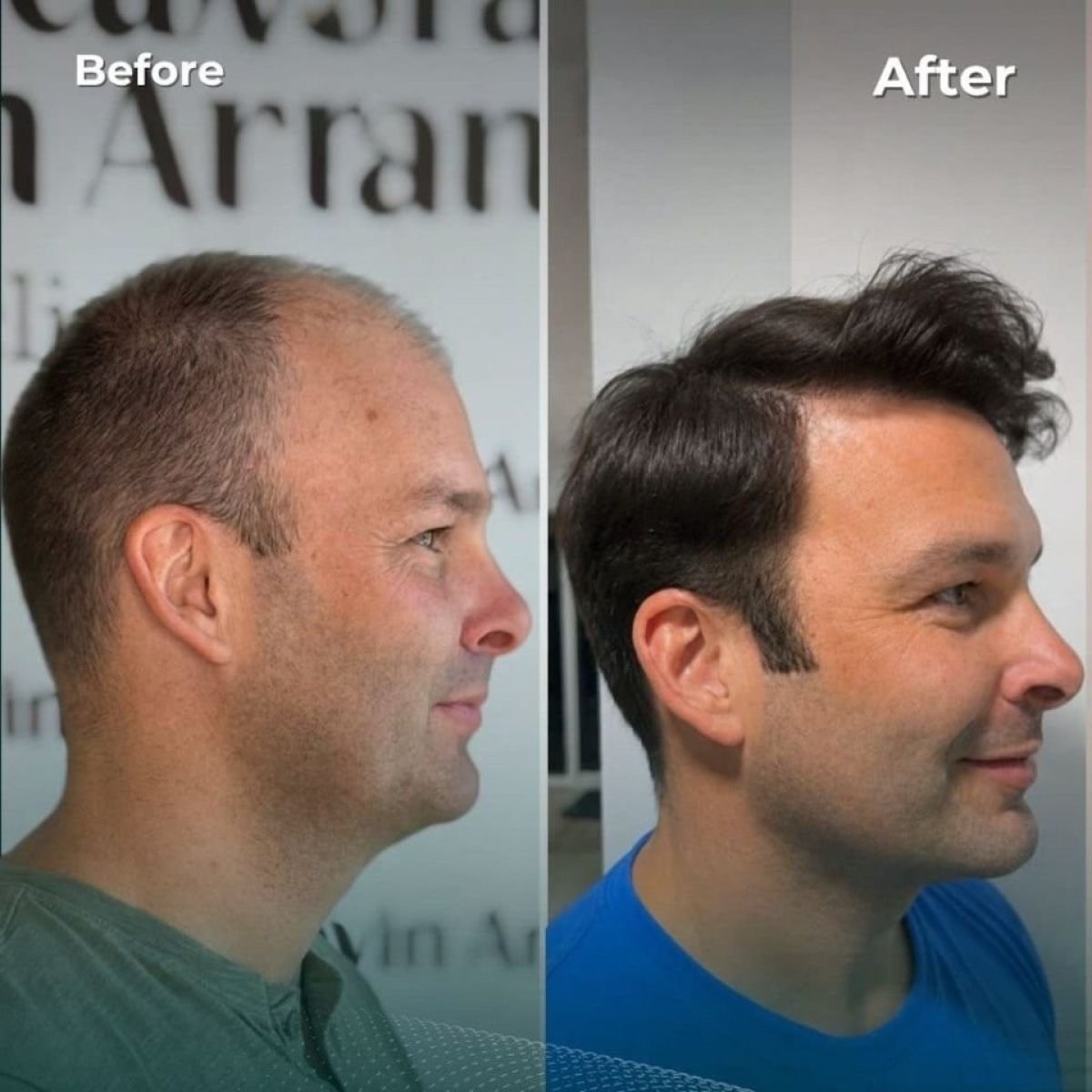 نتائج زراعة الشعر FUE قبل وبعد في NOVİN ARİANA SAĞLIK VE TURİZM LİMİTED ŞİRKETİ