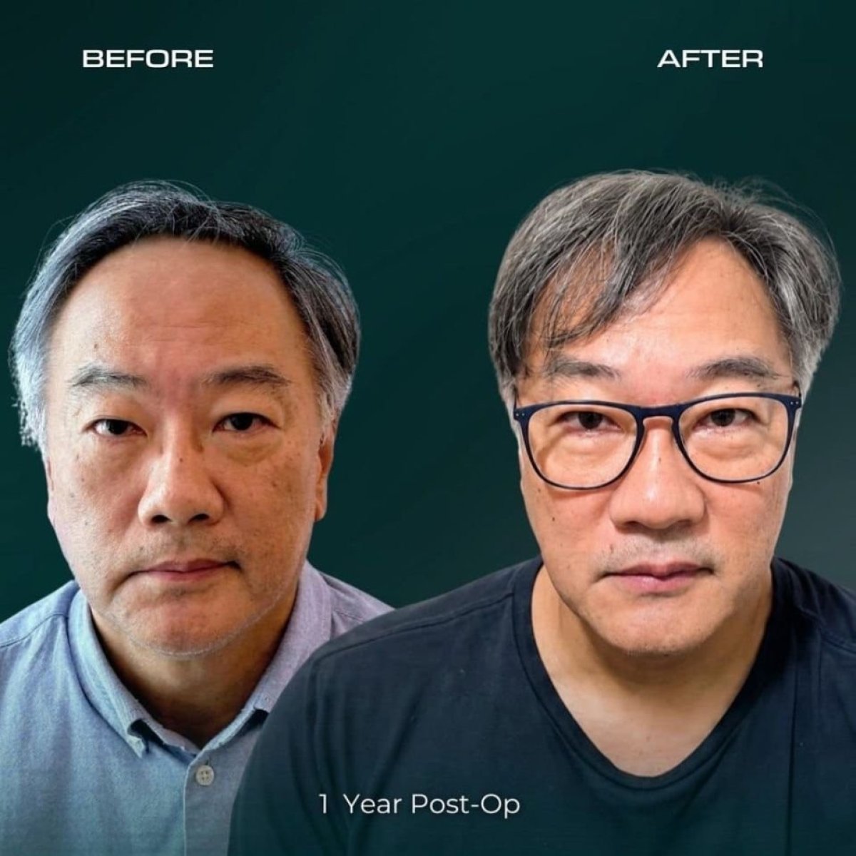 FUE hair transplant before and after results at NOVİN ARİANA SAĞLIK, 1 year post-op
