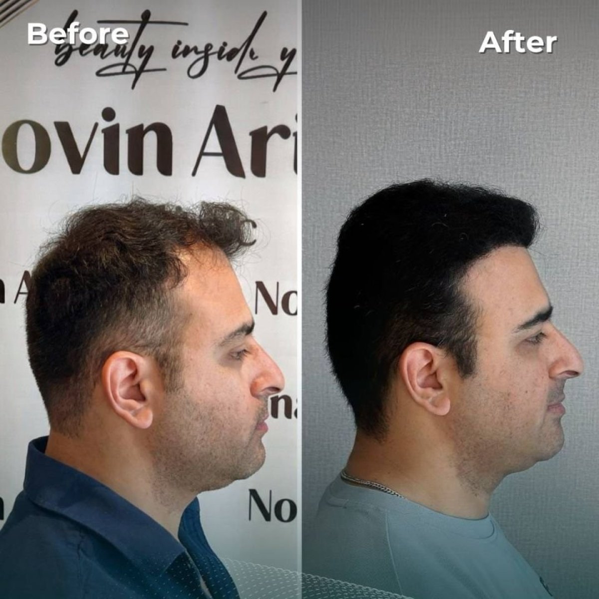 نتيجة زراعة الشعر FUE قبل وبعد في NOVİN ARİANA SAĞLIK VE TURİZM LİMİTED ŞİRKETİ