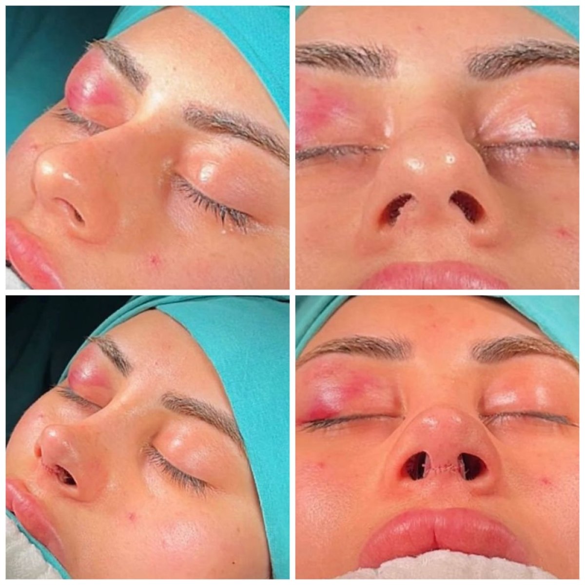نتائج تجميل الأنف التصحيحي في NOVİN ARİANA SAĞLIK VE TURİZM LİMİTED ŞİRKETİ، تصحيح الأنف