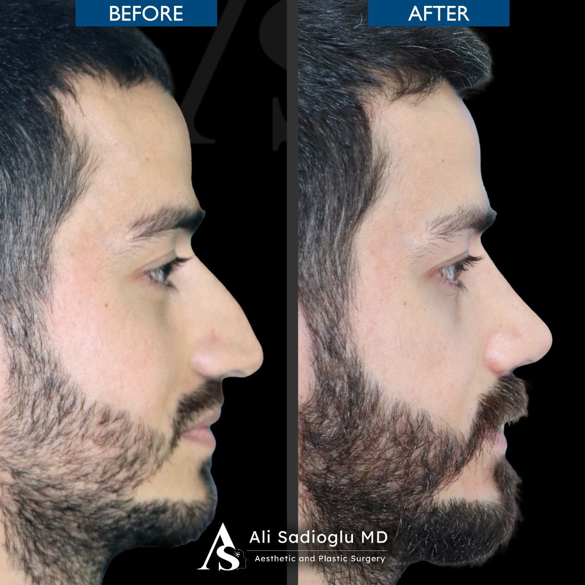 Before and after rhinoplasty results at Dr. Safa Manav Clinic, improved nose profile