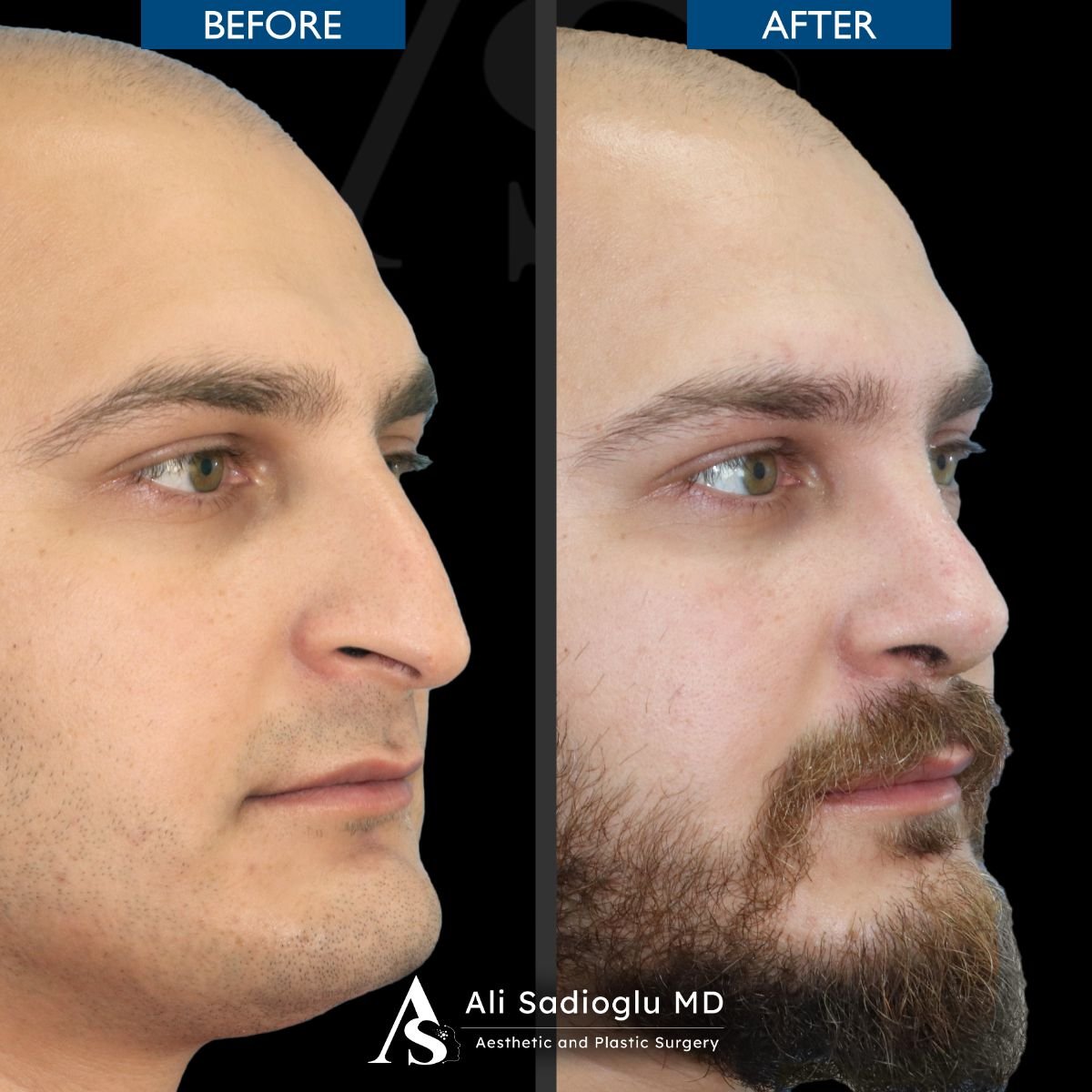 Resultados de rinoplastia antes y después en Dr. Safa Manav Clinic, mejora de la forma nasal