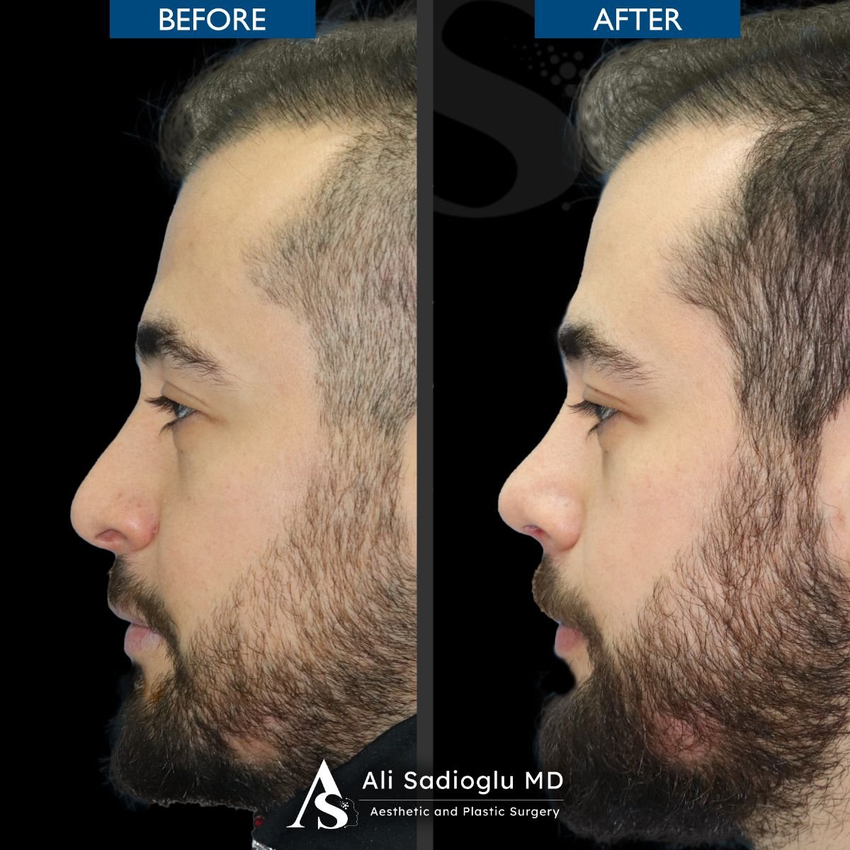 Before and after rhinoplasty results at Dr. Safa Manav Clinic, improved nose profile