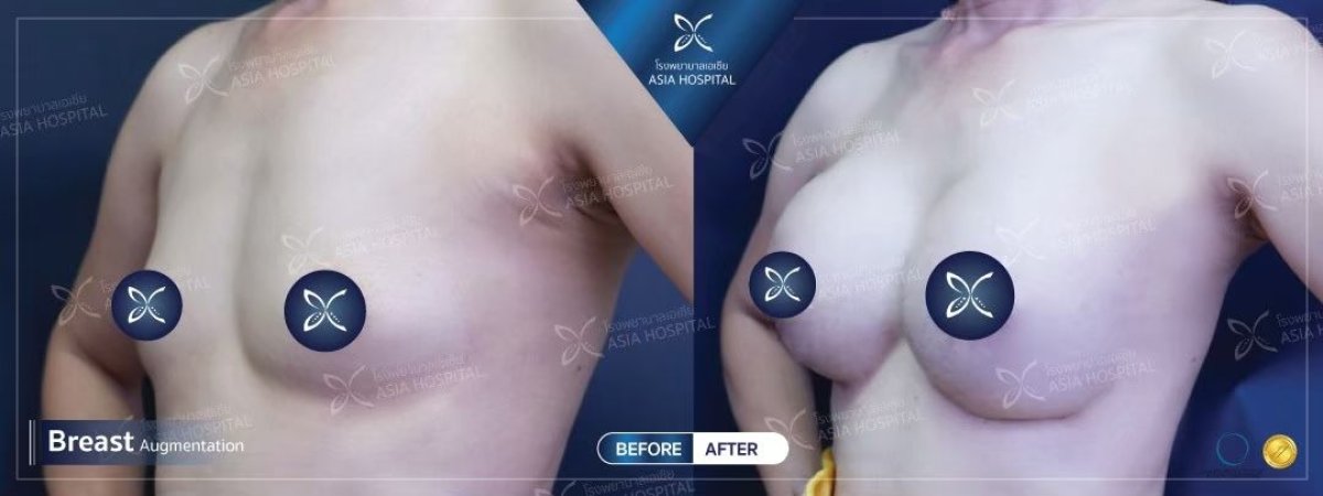 Résultats avant et après révision d’implants mammaires à Asia Cosmetic Hospital, forme améliorée