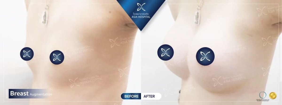 Résultats avant et après révision d’implants mammaires à Asia Cosmetic Hospital, forme améliorée