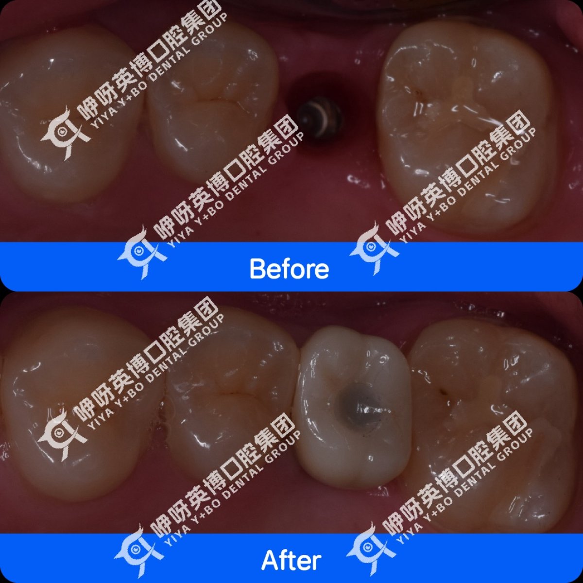 Resultados de implante dental antes y después en Shanghai Y+bo Dental Clinic, molar restaurado