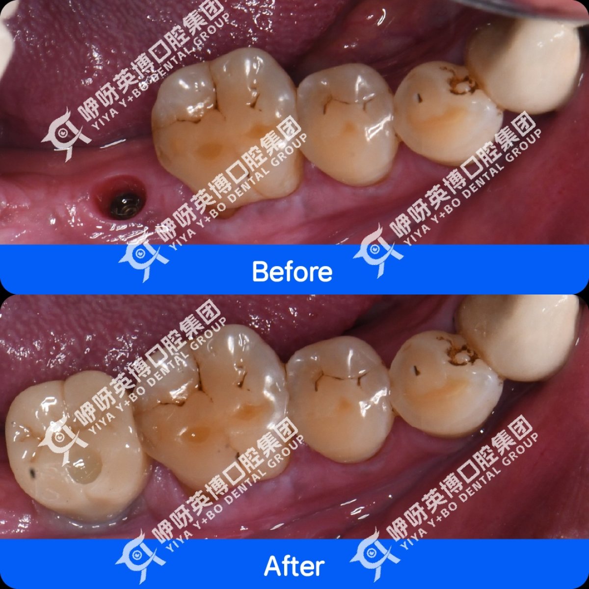 Resultados de implante dental antes y después en Shanghai Y+bo Dental Clinic, diente restaurado