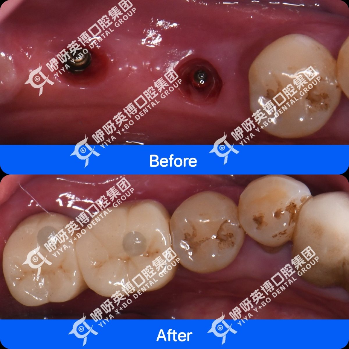 Resultados de implantes dentales antes y después en Shanghai Y+bo Dental Clinic, molares restaurados