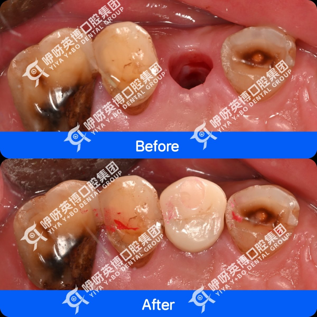 Resultados de implante dental antes y después en Shanghai Y+bo Dental Clinic, diente restaurado