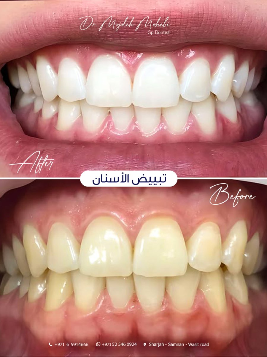 نتائج تبييض الأسنان قبل وبعد في عيادة د. مجده محبي، ابتسامة أكثر إشراقًا
