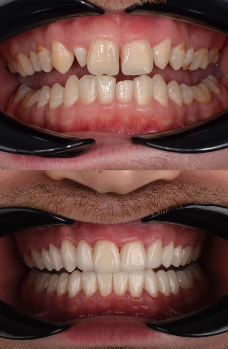 Before and after veneers at Astra Dental Clinic – smile makeover with natural-looking results