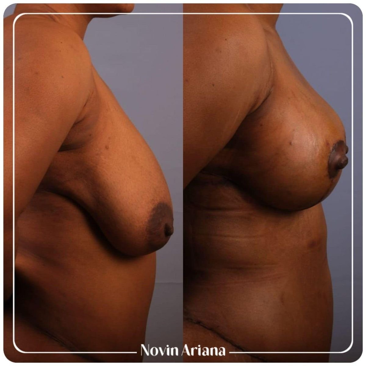 نتائج تصغير الثدي قبل وبعد في NOVİN ARİANA SAĞLIK VE TURİZM LİMİTED ŞİRKETİ