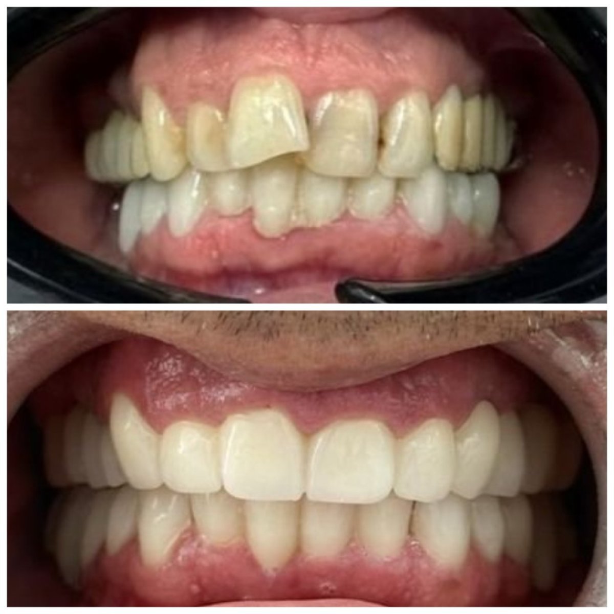 Antes y después de coronas de zirconia en Santa Caterina Clinic Dental & Aesthetic Medicine
