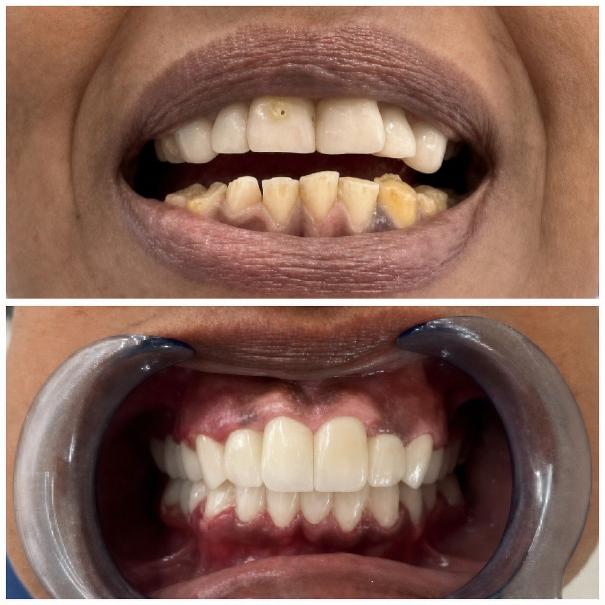 Antes y después de coronas de zirconia en Santa Caterina Clinic Dental & Aesthetic Medicine