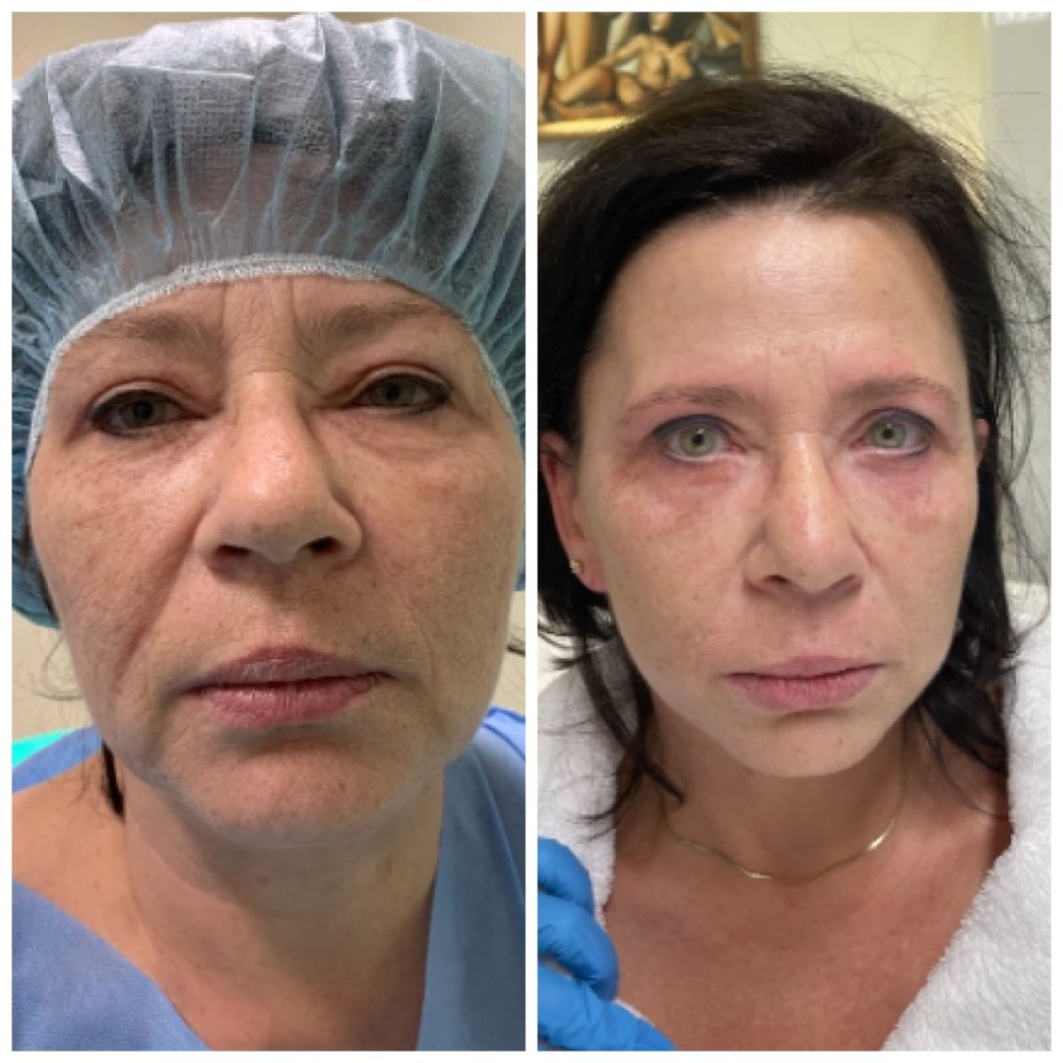 نتائج شد الوجه العميق قبل وبعد في عيادة Radzikowska لجراحة التجميل، تجديد شباب الوجه