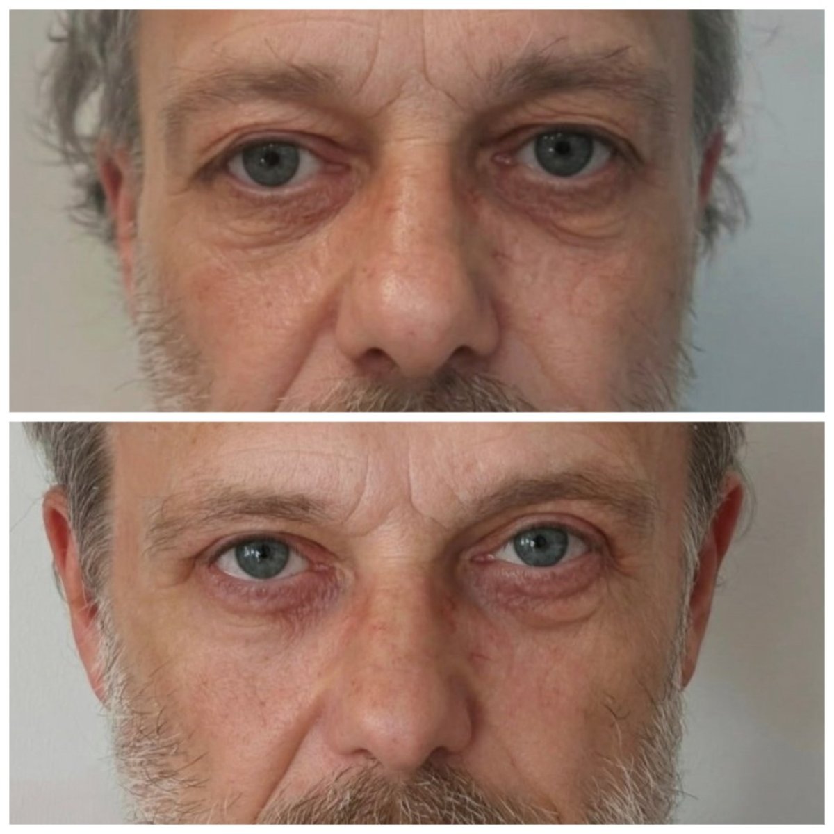 Efekty plastyki powiek górnych i dolnych w Radzikowska Plastic Surgery Clinic