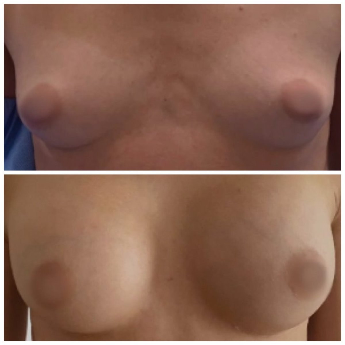 نتائج قبل وبعد تكبير الثدي في عيادة Radzikowska لجراحة التجميل