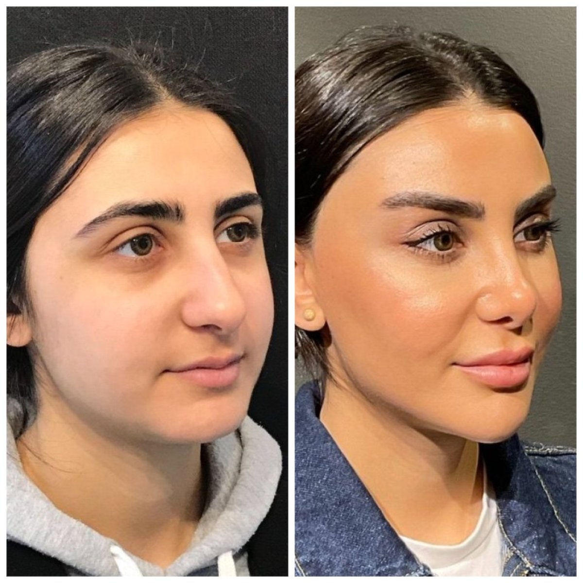 نتيجة عملية تجميل الأنف قبل وبعد في عيادة د. فوركان كارابيكميز أنقرة