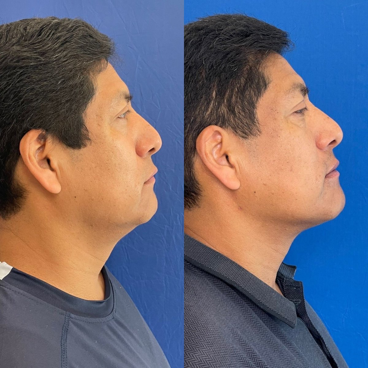 Vorher-nachher-Ergebnis Kinn-Liposuktion bei Zafir Medical Center, verbesserte Kinnlinie