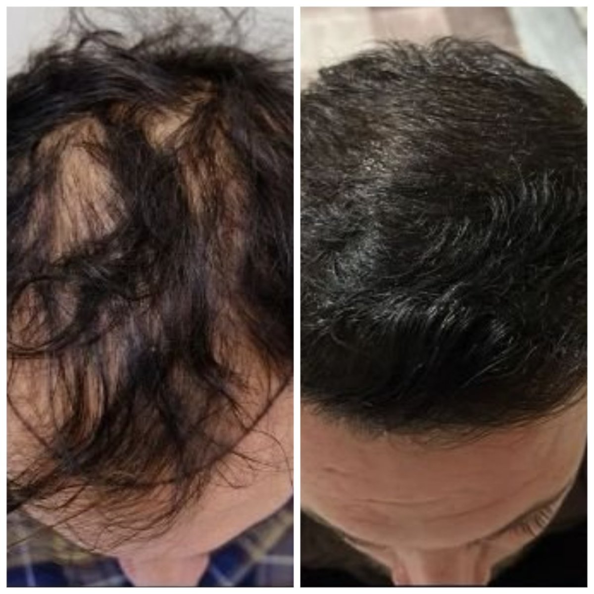 نتائج قبل وبعد زراعة الشعر FUE في مركز Medeks، كثافة شعر مستعادة