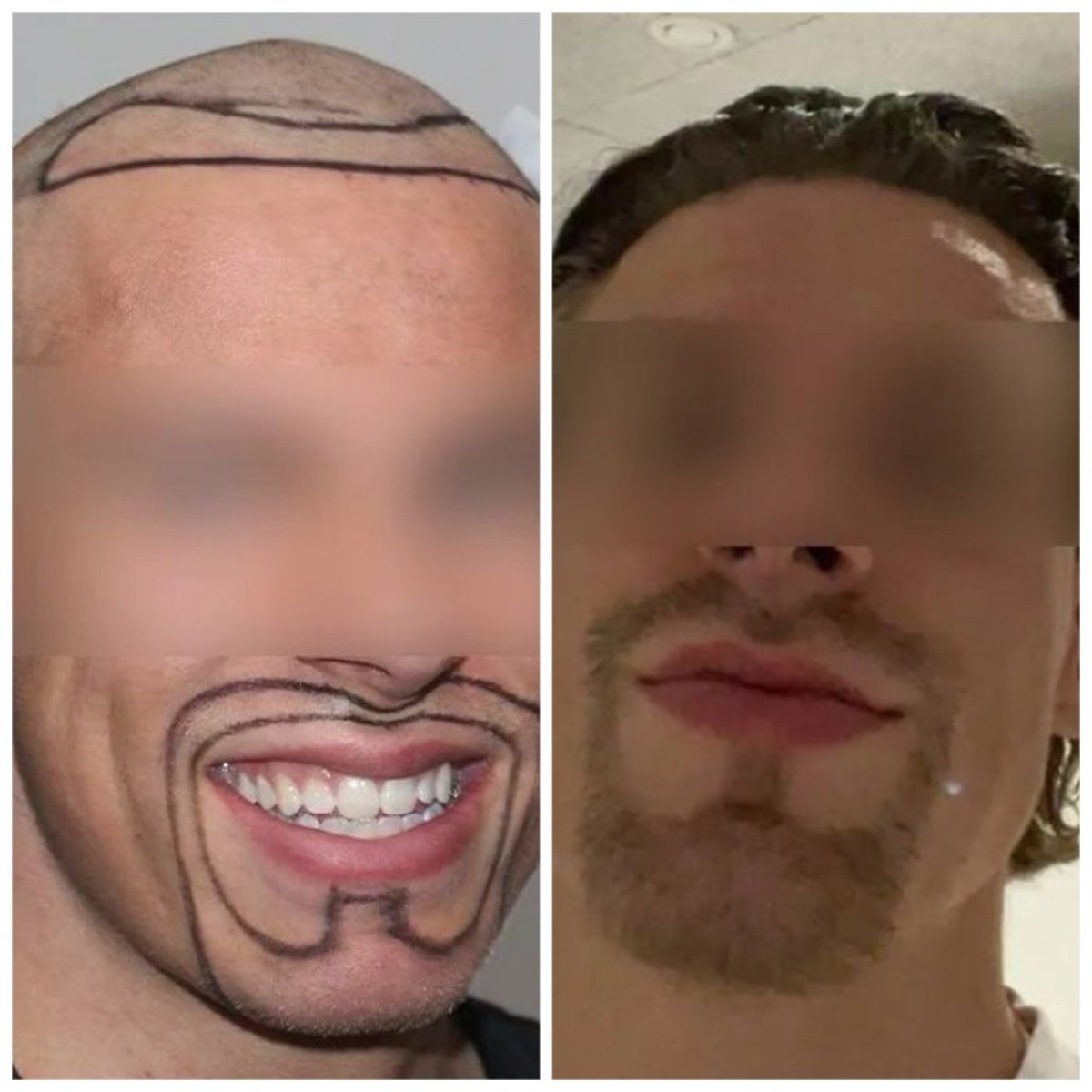 نتائج زراعة اللحية قبل وبعد في مركز Medeks Hair Center – لحية أكثر كثافة