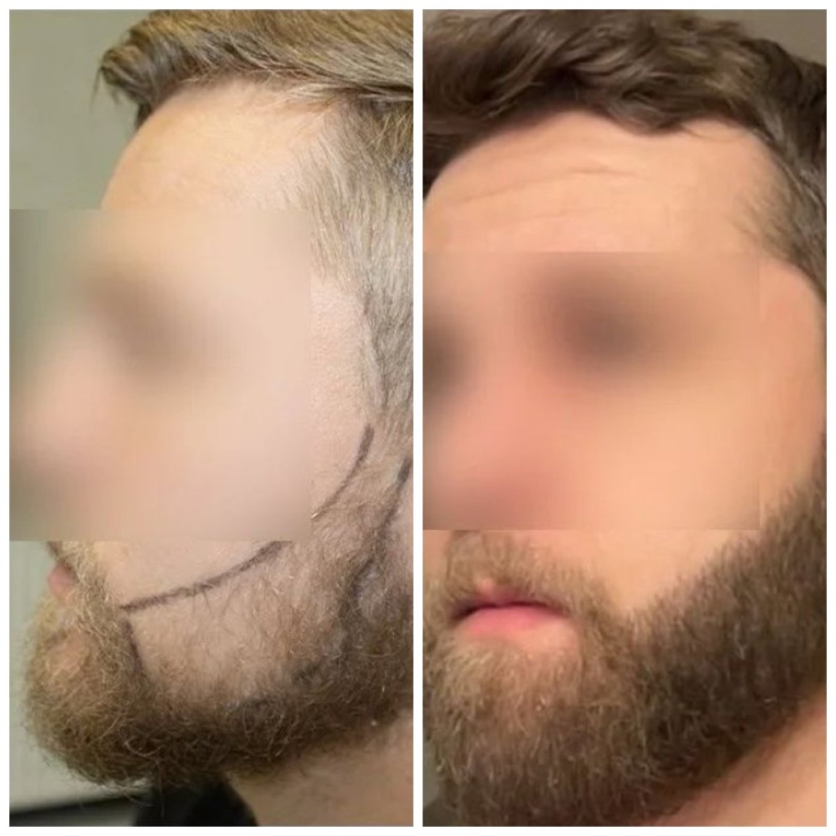 نتائج زراعة اللحية قبل وبعد في مركز Medeks Hair Center، لحية أكثر كثافة