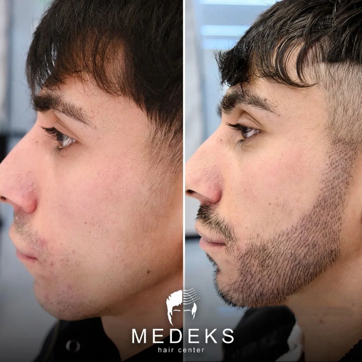 Before and after beard transplant results at Medeks Hair Center, fuller beard appearance