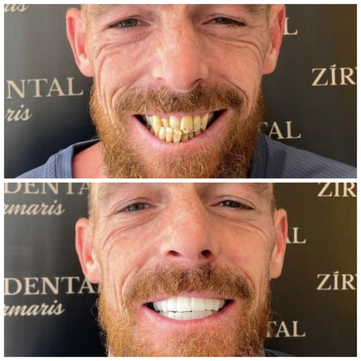 Resultados antes y después de coronas de zirconia en Marmaris Zirve Dental – transformación de sonrisa