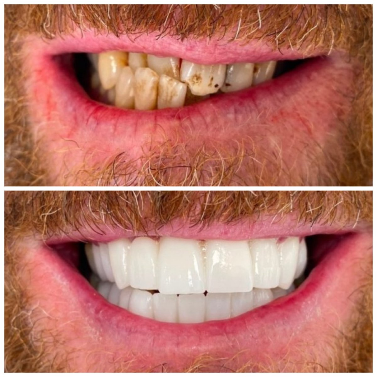 Resultados antes y después de coronas de zirconia en Marmaris Zirve Dental – transformación de sonrisa