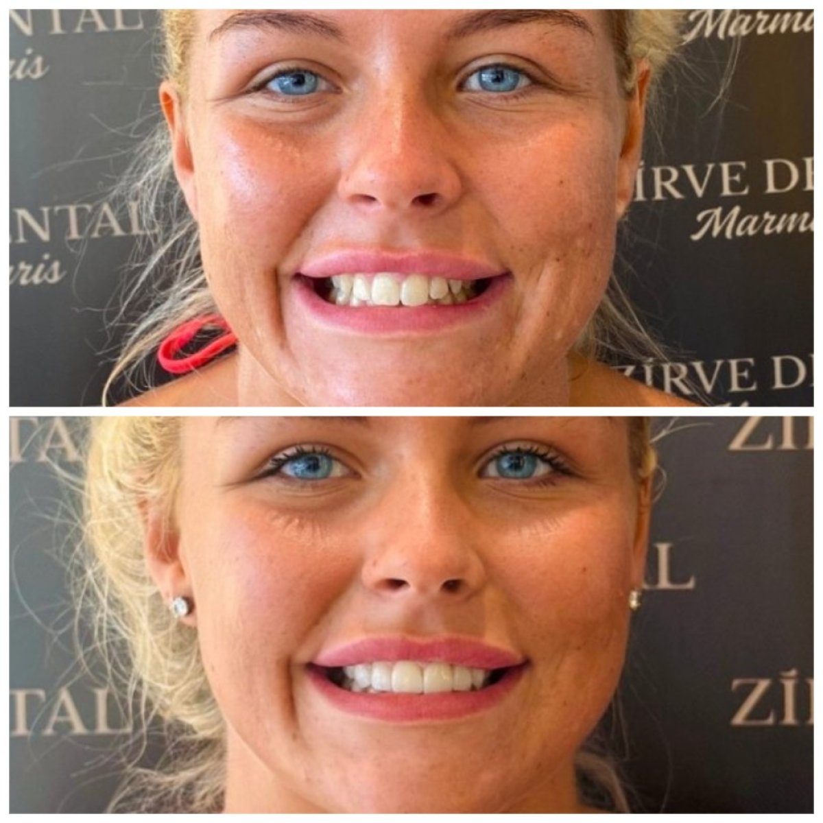 Resultados antes y después de coronas de zirconio en Marmaris Zirve Dental, transformación de sonrisa