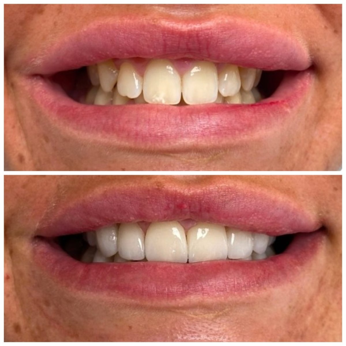 Результаты до и после установки циркониевых коронок в Marmaris Zirve Dental – улучшение улыбки