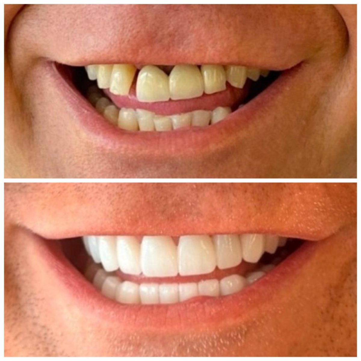 Resultados antes y después de coronas de zirconio en Marmaris Zirve Dental, sonrisa mejorada