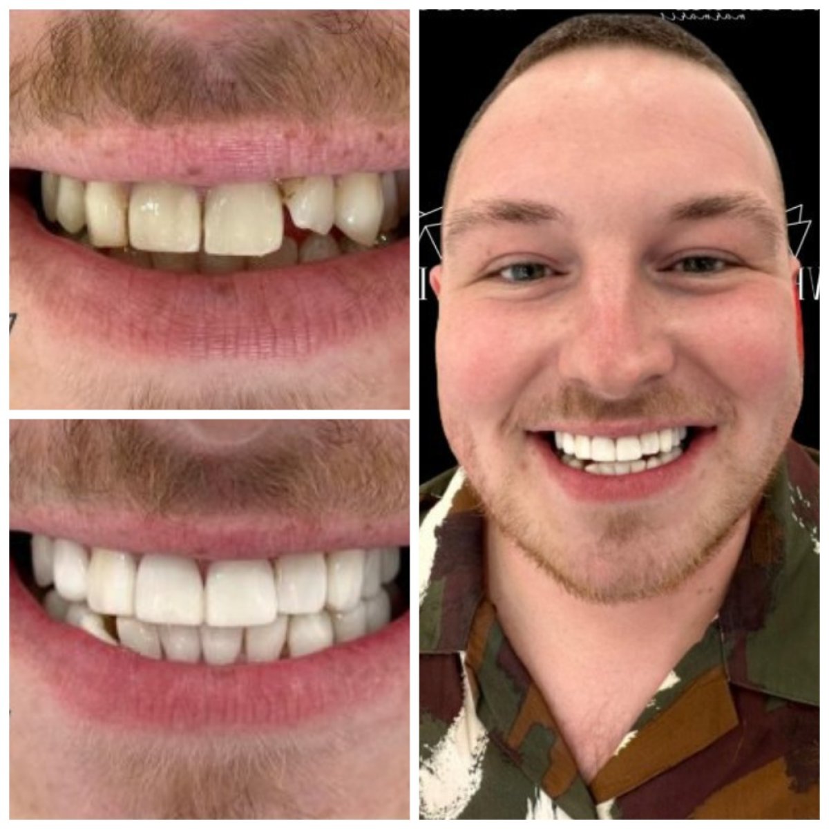 Результаты до и после бондинга зубов в Marmaris Zirve Dental – улучшение улыбки