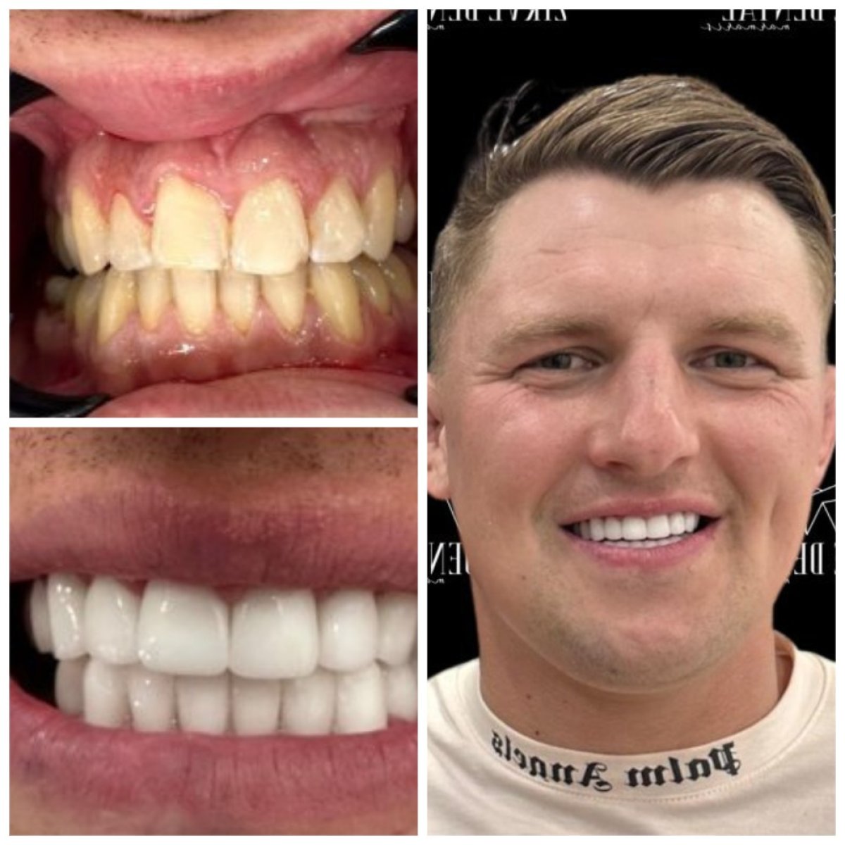Resultados antes y después de carillas de zirconio en Marmaris Zirve Dental, transformación de sonrisa