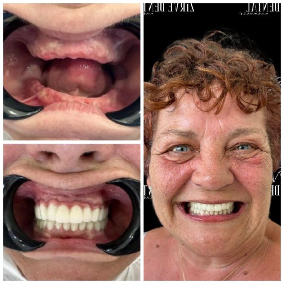 Resultado antes y después de implantes All-on-6 en Marmaris Zirve Dental, sonrisa restaurada