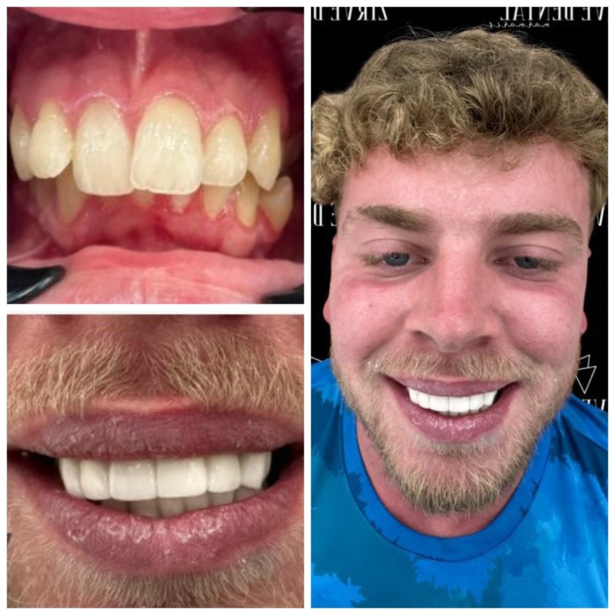 Before and after zirconia crown results at Marmaris Zirve Dental, smile transformation visible