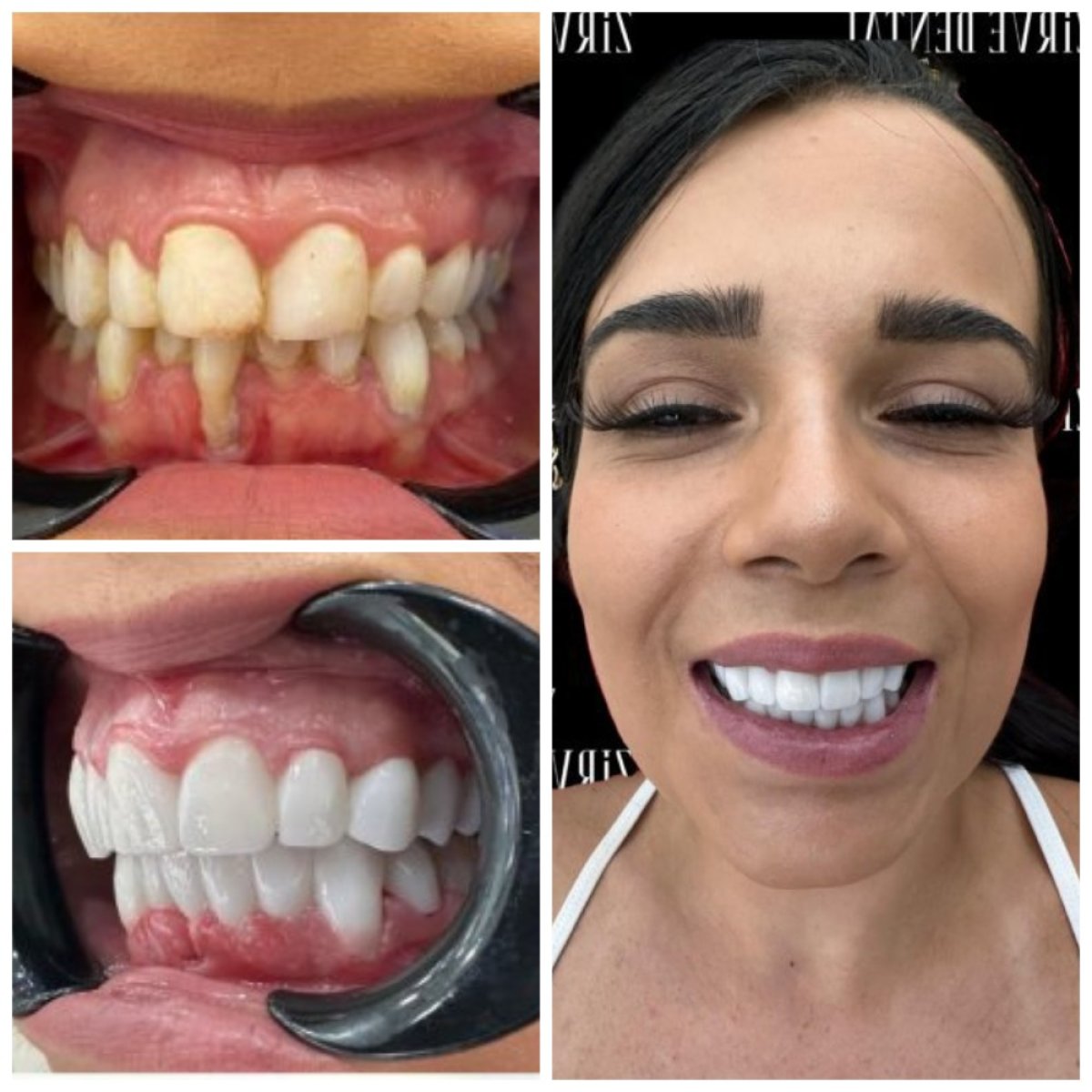 Before and after zirconia veneers at Marmaris Zirve Dental – smile makeover results