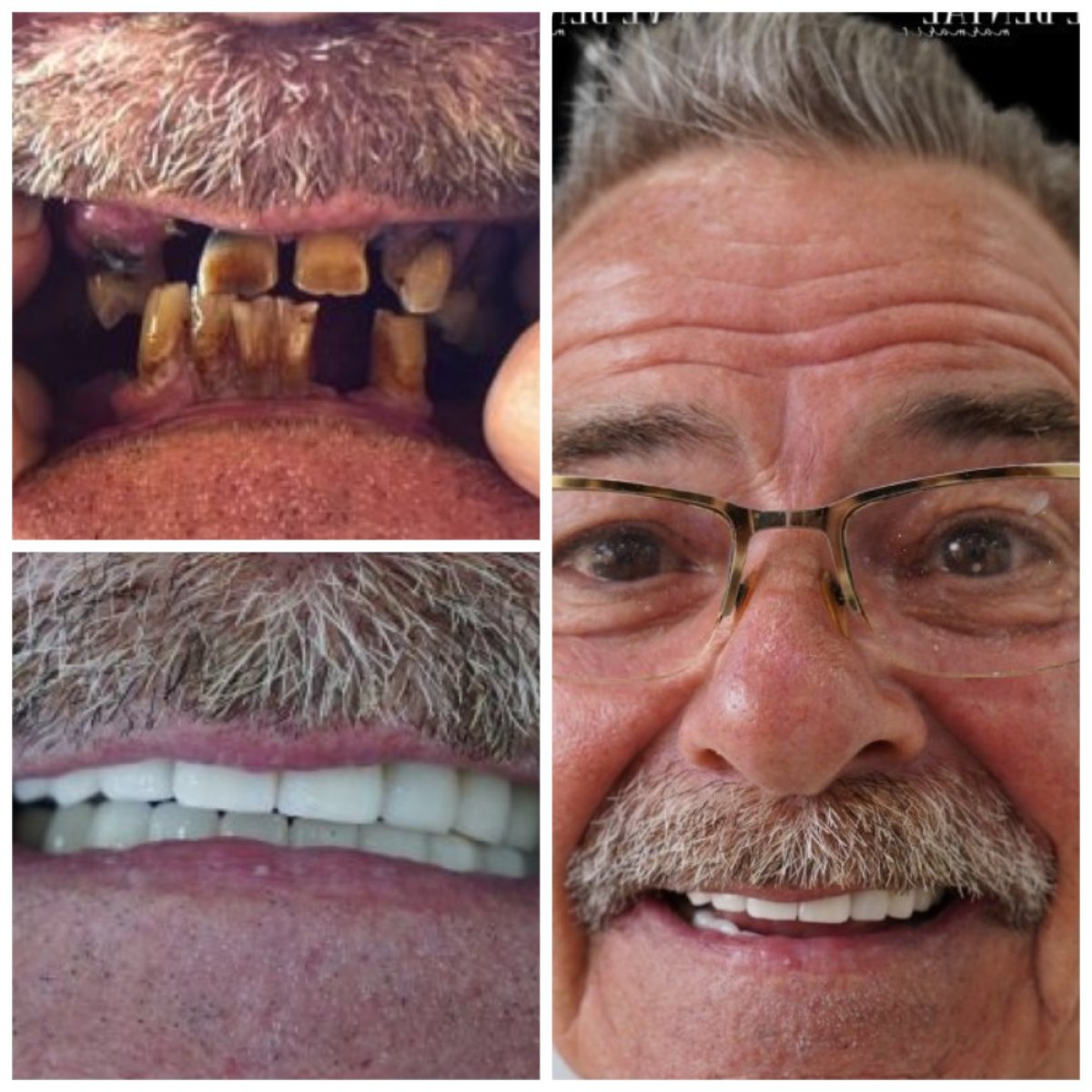 Результати до і після імплантації All-on-6 за один день у клініці Marmaris Zirve Dental