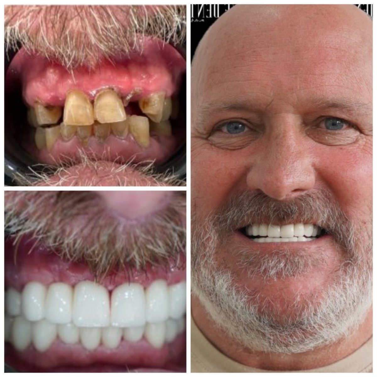 Resultados antes y después de puente dental de zirconia en Marmaris Zirve Dental, sonrisa mejorada