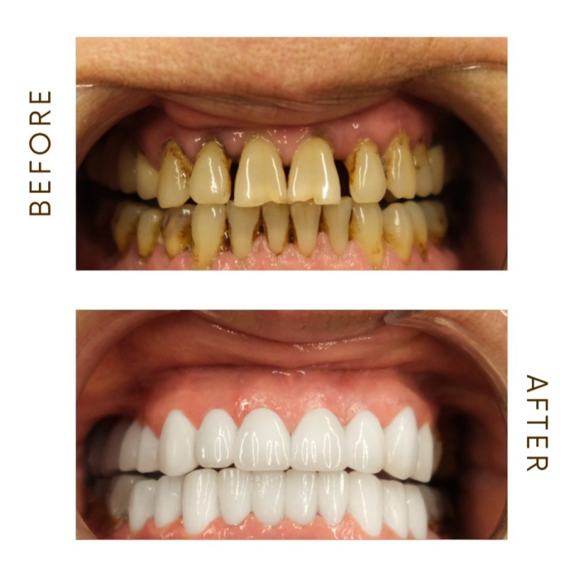 Before and after Hollywood Smile results – dental veneers for whiter, even teeth transformation