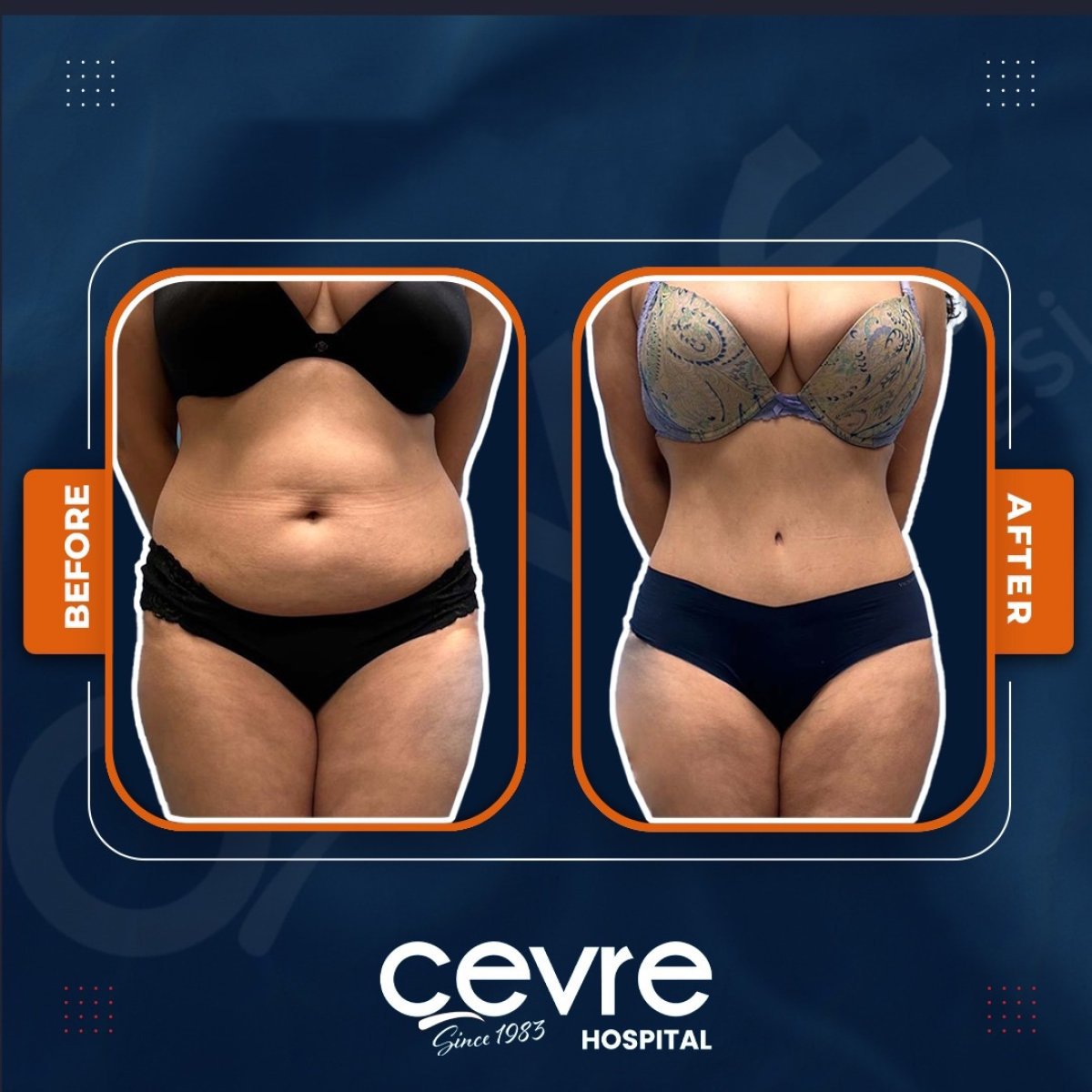 نتائج شفط دهون البطن قبل وبعد في مركز Adem and Havva Medical Center، خصر أنحف