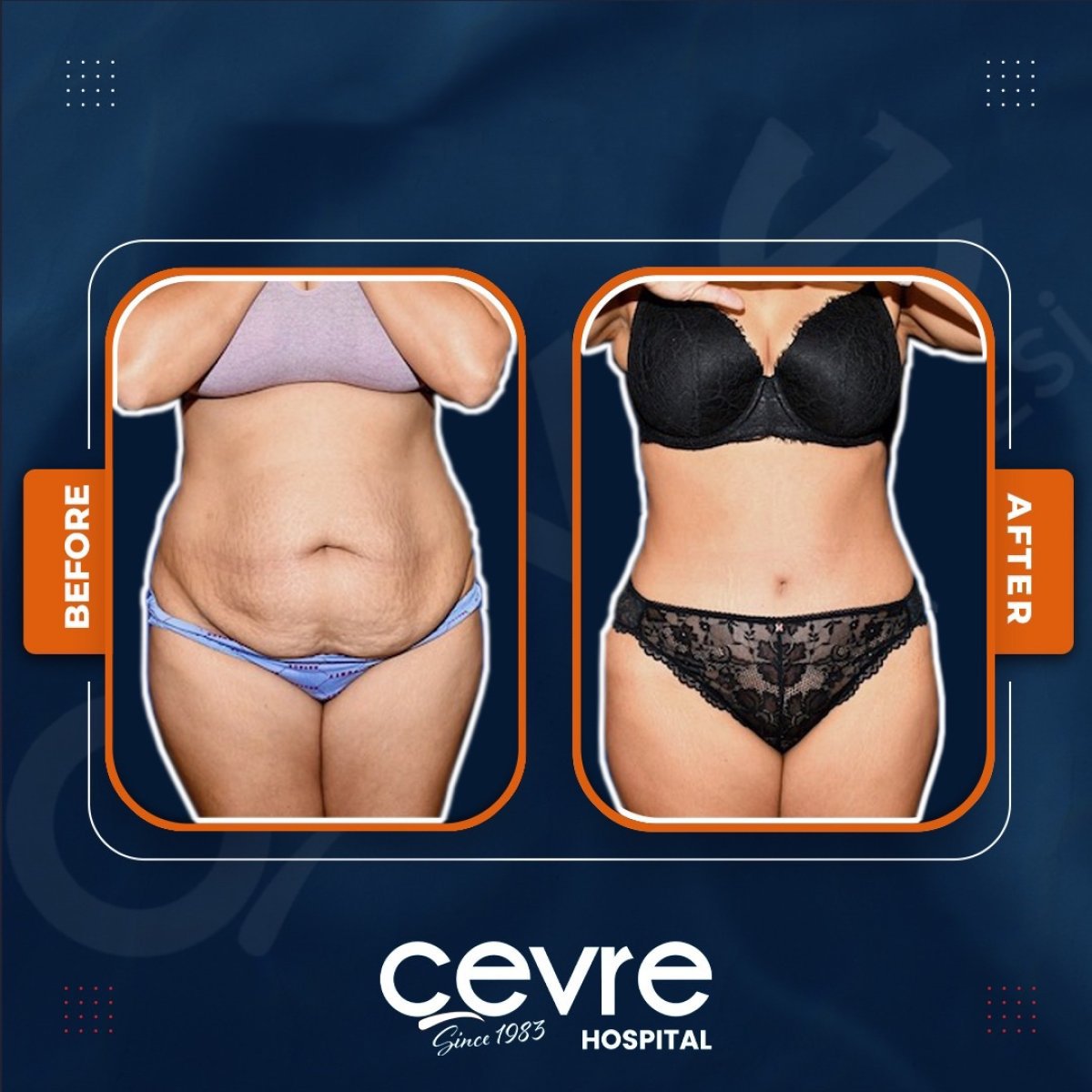 نتائج شفط دهون البطن قبل وبعد في Adem and Havva Medical Center، تنسيق القوام